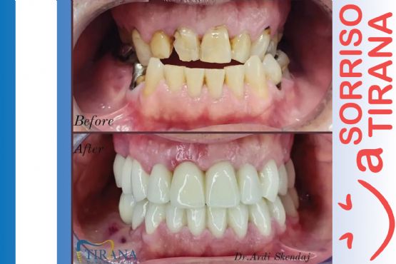 Implantologji / Implantologia Dentale / Implantet Dentare Cmimet / Implantet Dentare ne Tirane / Kellef Porcelani  Implantet e Dhembeve Tirane / Dhembe me Mbjellje / Mbjellje Dhembi / Dhembe Porcelani dhe Zirkoni / grafi panoramex 3d